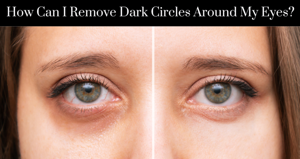 How Can I Remove Dark Circles Around My Eyes