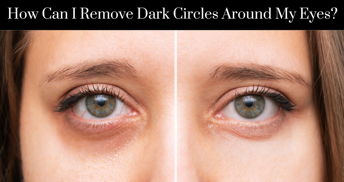 How Can I Remove Dark Circles Around My Eyes