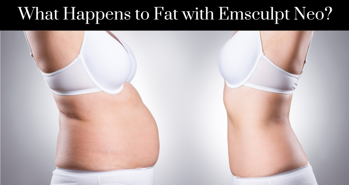 What Happens to Fat with Emsculpt Neo - New