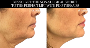 BussoLyft: The Non-Surgical Secret to the Perfect Lift with PDO Threads